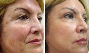 κλασματική αναζωογόνηση του δέρματος πριν και μετά τις φωτογραφίες