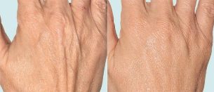 Δέρμα χεριών πριν και μετά την κλασματική θεραπεία
